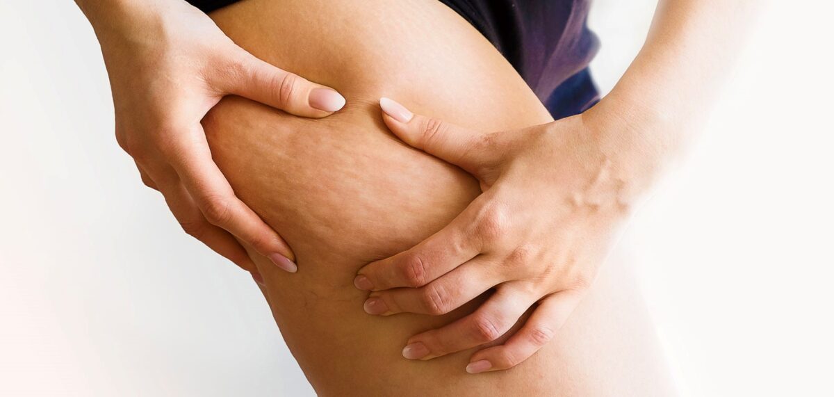 FenixLife 840x400 Cellulite